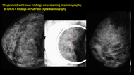 Problem Solving Breast MRI: A Case-Based Approach