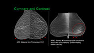 Multi-modality Review of Vascular Conditions of the Breast