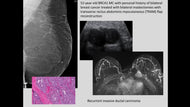 BRCA-Related Malignancies