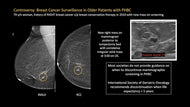 Breast Cancer Surveillance in Patients with Prior History of Breast Cancer: Updates and Controversies