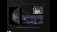 Case Reviews: Finding Breast Cancer with 3D Breast Tomosynthesis - Efficiency Learning Systems