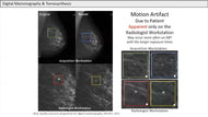 Digital Mammography & Tomosynthesis: Principles and Practical Aspects with recent improvements - Efficiency Learning Systems