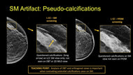 2-D Mammography Synthesized from Tomosynthesis: Strengths, Pitfalls, Artifacts - Efficiency Learning Systems