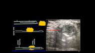 Breast Biopsy: Techniques and Tips