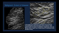 Calcifications on Digital Breast Tomosynthesis: Challenges and Advantages of Implementing Synthesized View