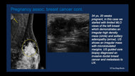 Breast Cancer in Young Women (Under the Age of Forty)