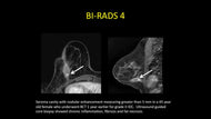 High Risk Surveillance – Mammographic and MRI Surveillance after Breast Cancer