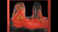 Breast MRI: Evolution, and Current Cases
