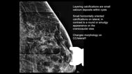 Everything you Wanted to Know About Calcifications
