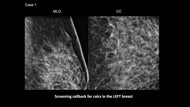 Cracking the Case: Challenging Calcifications