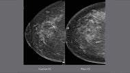 Breast Tomosynthesis: Comprehensive Breast Imaging Cases