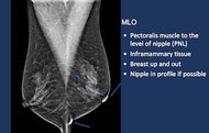 Breast Cancer Screening in the era of Tomosynthesis - Efficiency Learning Systems