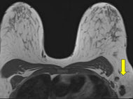Breast MRI Bootcamp - Efficiency Learning Systems