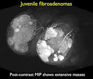 Breast MRI in Benign Breast Disease - Efficiency Learning Systems