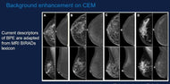 Contrast Enhanced Mammography: Techniques and Indication - Efficiency Learning Systems
