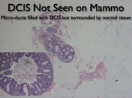 DCIS: How MRI Helps - Efficiency Learning Systems