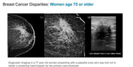 Disparities in Breast Cancer Outcome and Screening - Efficiency Learning Systems